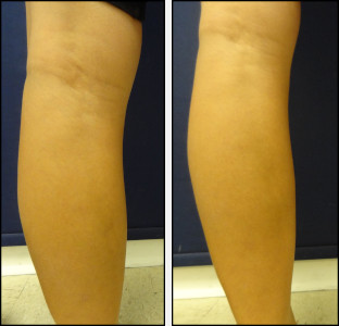 laser vein removal